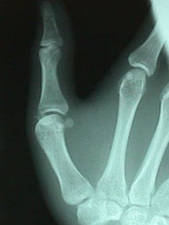 Lateral View of Thumb Fracture