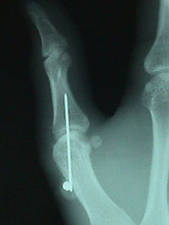 Lateral View of Thumb Fracture After Repair