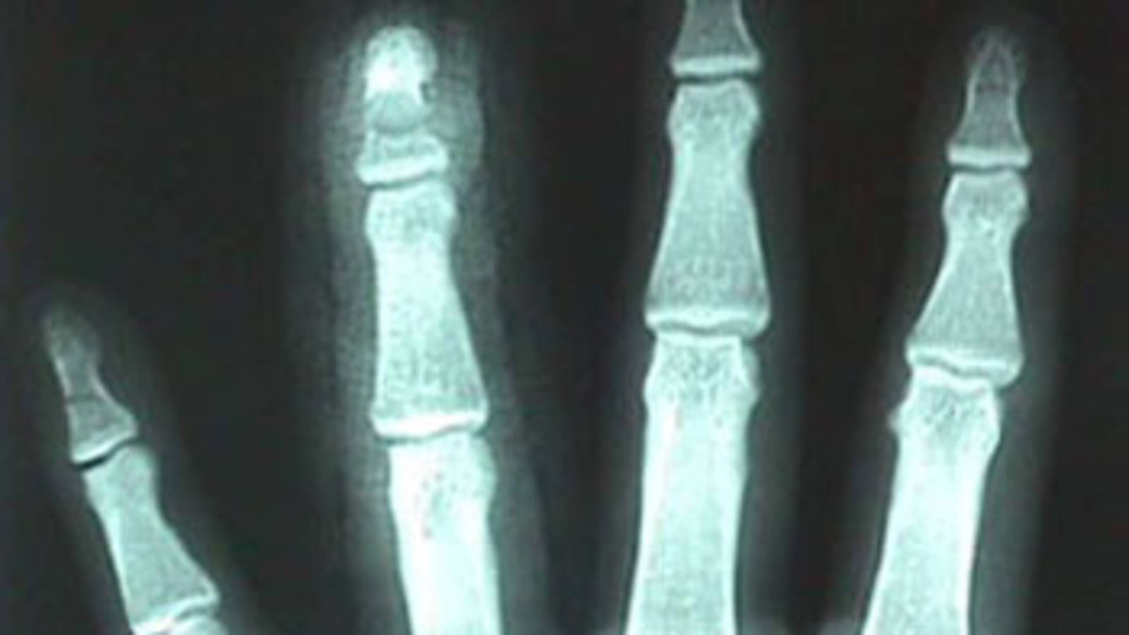 AP View of 2nd, 4th, 5th Finger (proximal phalanx) Fractures