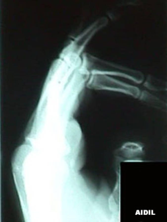 Lateral View of 2nd, 4th, 5th Finger (proximal phalanx) Fractures