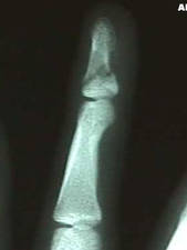 Oblique View of 4th Finger (distal phalanx) Fracture