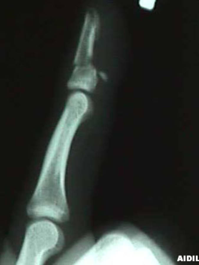 Lateral View of 4th Finger (distal phalanx) Fracture