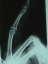 Lateral View of 4th Finger Mallet Fracture