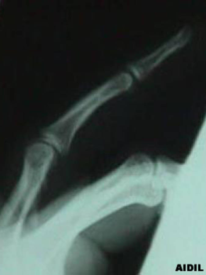 Lateral View of 4th Finger (proximal phalanx) Oblique Fracture