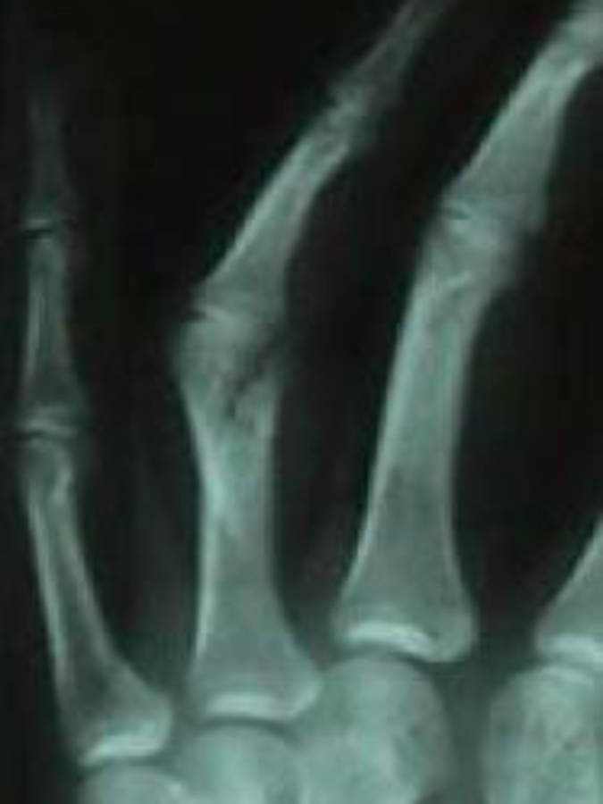 Oblique View of 4th Finger (proximal phalanx) Oblique Fracture