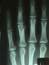 Lateral View of 3rd and 4th Metacarpal After Repair