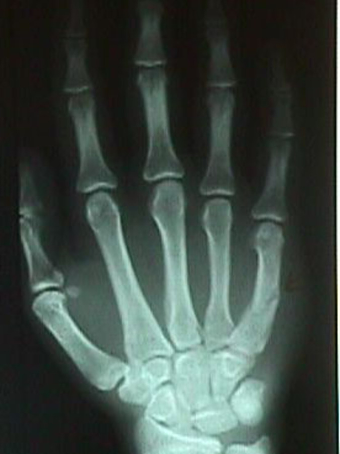 AP View of 5th Metacarpal (Boxer's) Fracture