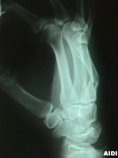 5th Metacarpal (Boxer's) Fracture (Lateral View)