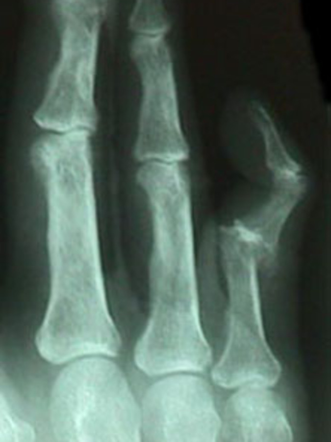 AP View of 5th Finger Dislocation