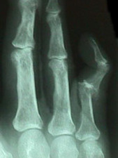 AP View of 5th Finger Dislocation