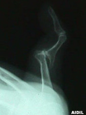 Lateral View of 5th Finger Dislocation