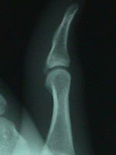 Lateral View of 5th Finger Dislocation After Repair