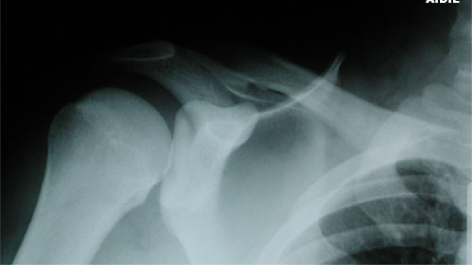 AP View of Scapula Fracture