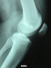 View of Epiphyseal Fracture of Distal Femur (Salter Harris III) Before Surgery