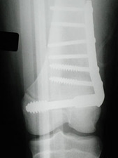 View of Epiphyseal Fracture of Distal Femur (Salter Harris III) After Surgery
