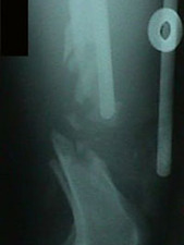 Lateral View of Femur Fracture During Surgery