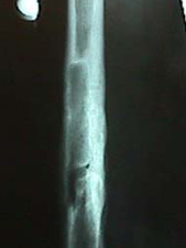 AP View of Femur Fracture with Hardware Removed