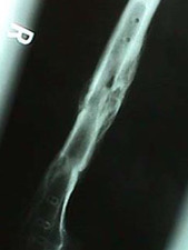 Lateral View of Femur Fracture with Hardware Removed