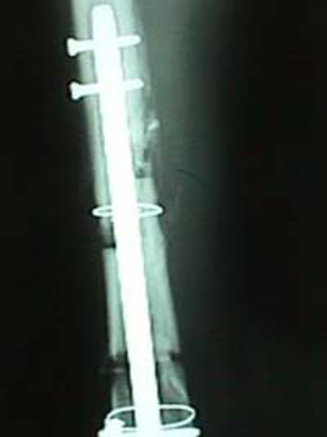 AP View of Femur Fracture Post Surgery