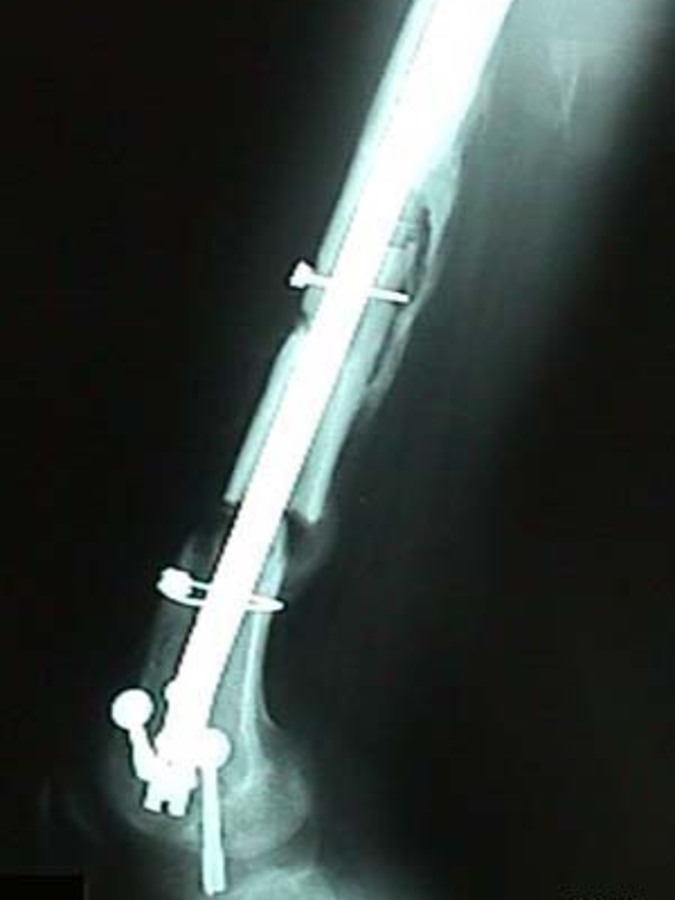 Lateral View of Femur Fracture Post Surgery
