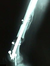 Lateral View of Femur Fracture Post Surgery