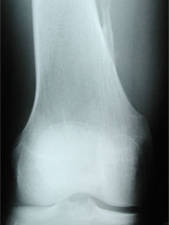 AP View of Osteochondroma-posterior femur