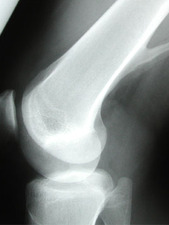 Lateral View of Osteochondroma-posterior femur