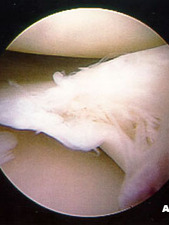 Arthroscopic View of Torn Lateral Meniscus