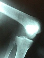 AP View of Dislocated Knee