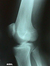 Lateral View of Dislocated Knee