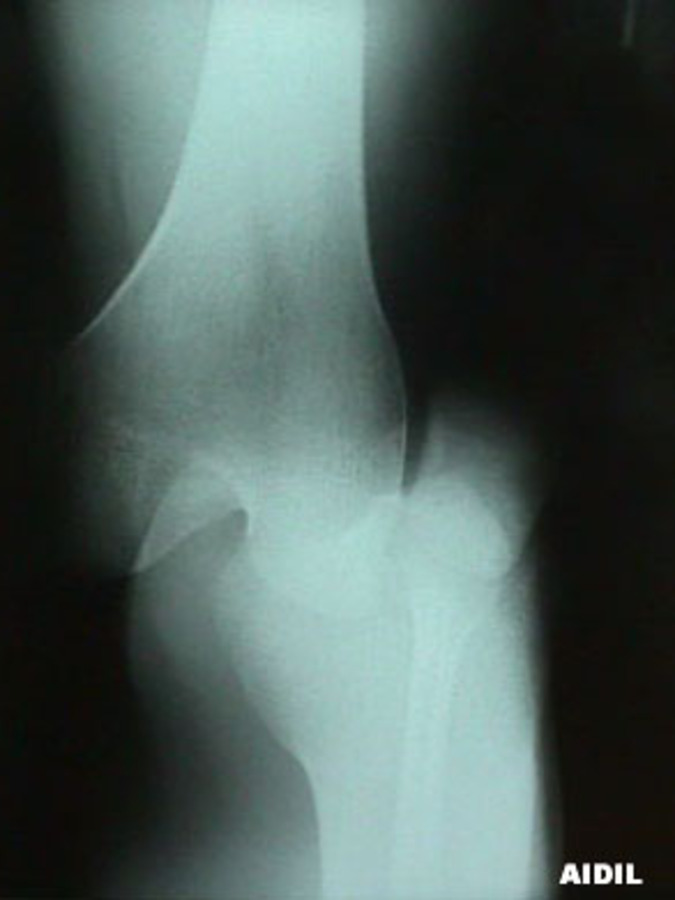 Oblique View of Dislocated Knee