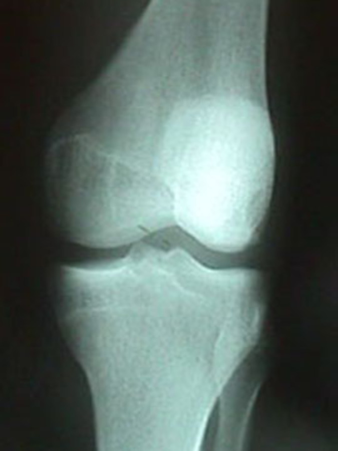Lateral View of Dislocated Knee After Reduction