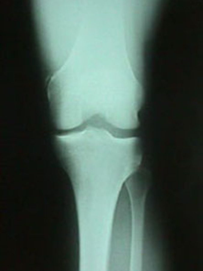 AP View of MCL Avulsion Fracture