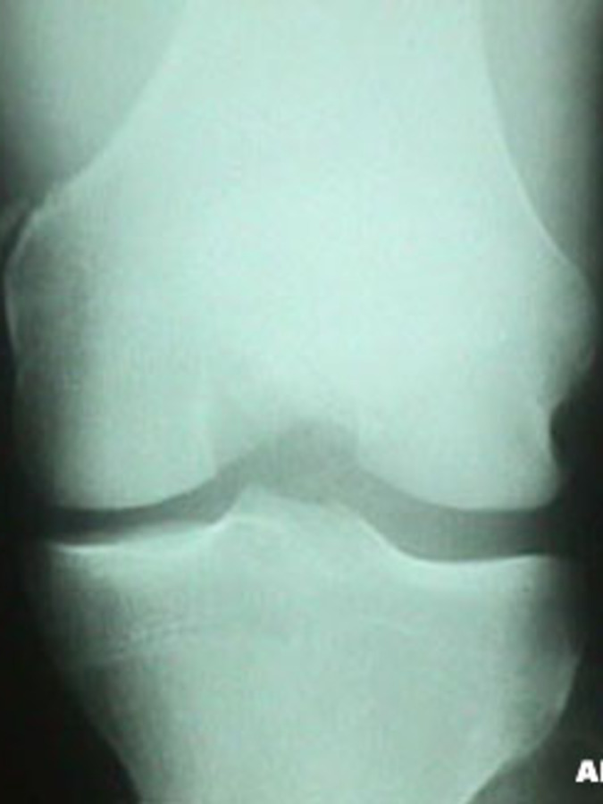 Close-up AP View of MCL Avulsion Fracture