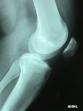 Lateral View of Patella Malalignment