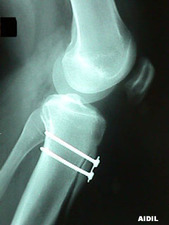 Lateral View of Patella Malalignment After Repair