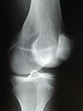Lateral View of Patella Fracture