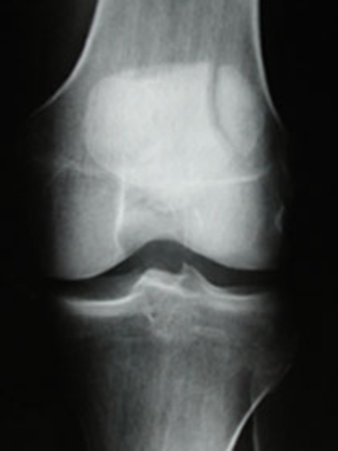 AP View of Patella Fracture