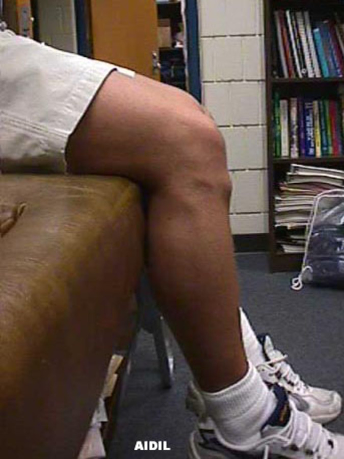 Lateral View of Knee with Osgood-Schlatter Disease