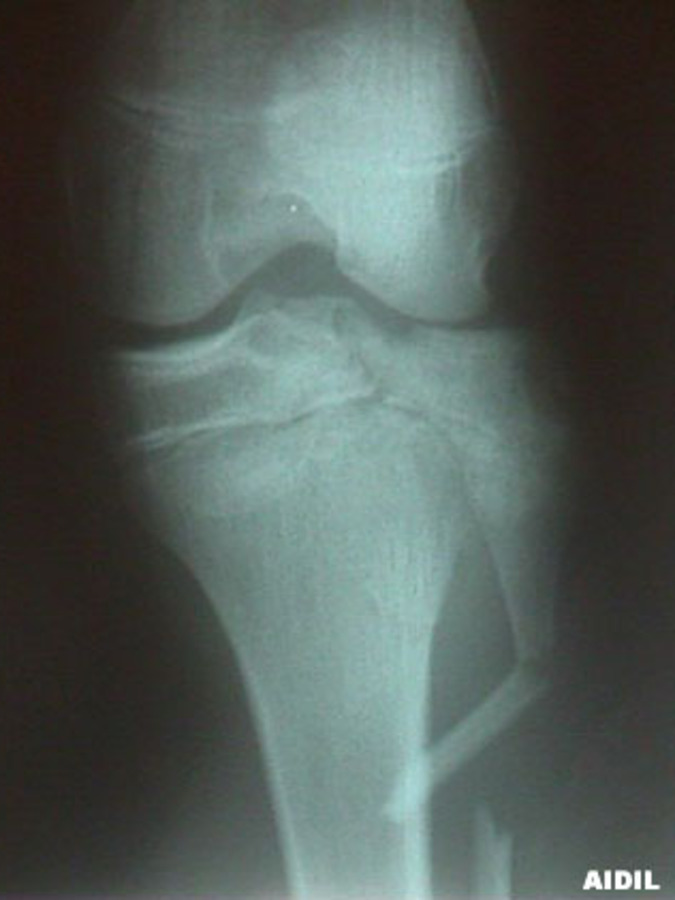 AP View of Tibial Plateau with Fibula Fracture