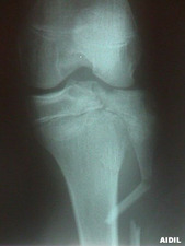 AP View of Tibial Plateau with Fibula Fracture