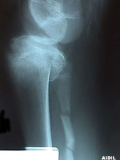 Lateral View of Tibial Plateau with Fibula Fracture