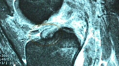 MRI of Torn ACL