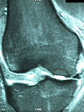 MRI of Osteochondral Fracture