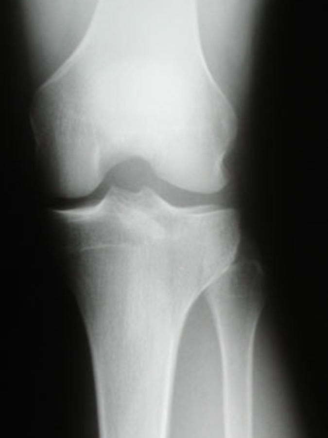 AP View of Tibial Plateau Fracture