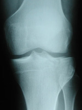 Close-up AP View of Tibial Plateau Fracture