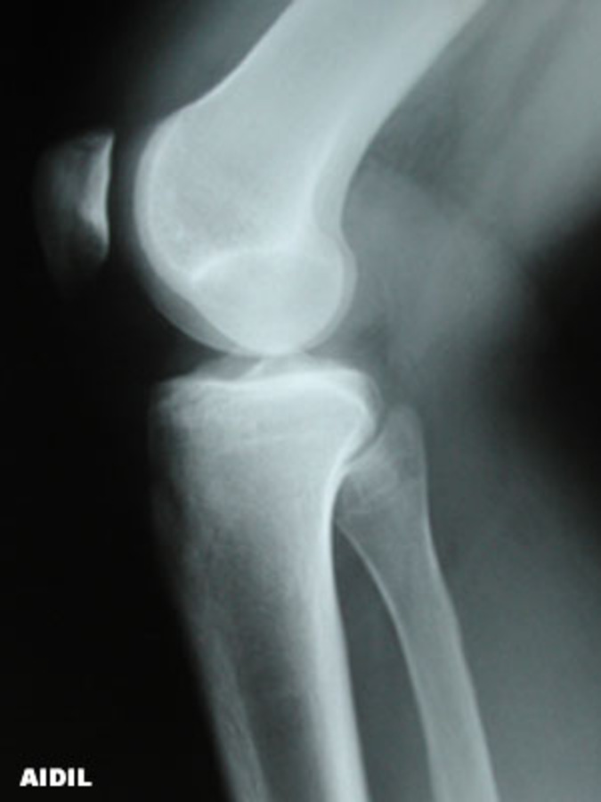 Lateral View of Tibial Plateau Fracture