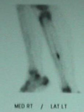 Medial Right/Lateral Left View of Bone Scan of Tibial Stress Fracture
