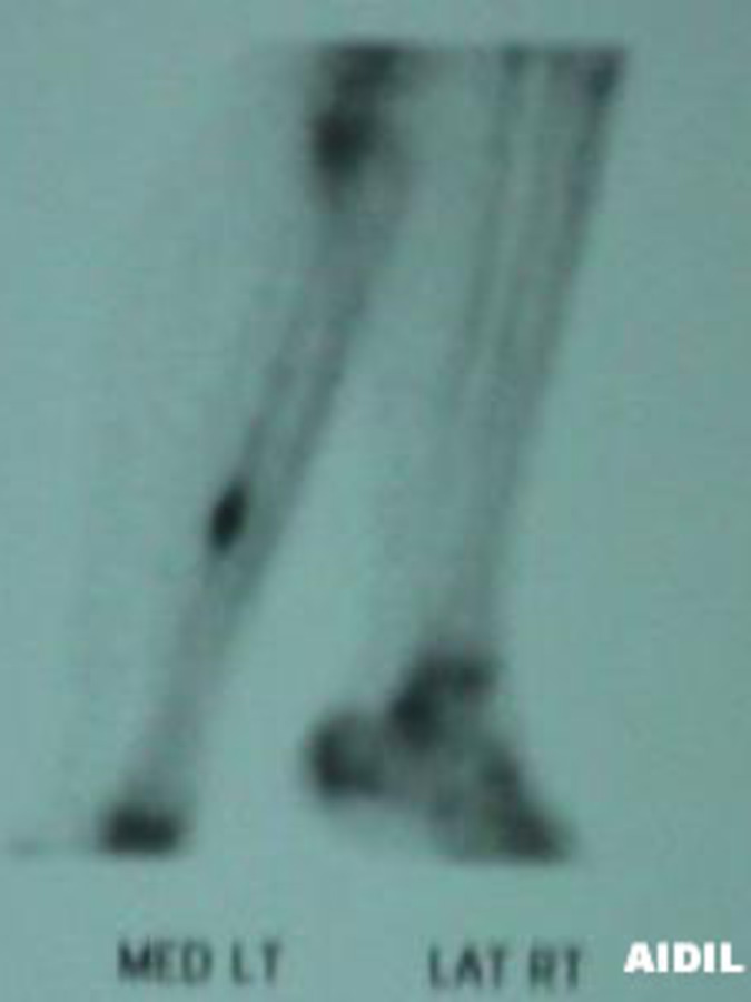 Lateral Right/Medial Left View of Bone Scan of Tibial Stress Fracture