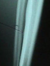 AP View of X-Ray of Tibial Stress Fracture